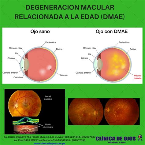 Cl Nica De Ojos Oftalmic L Ser Degeneracion Macular Relacionada A La