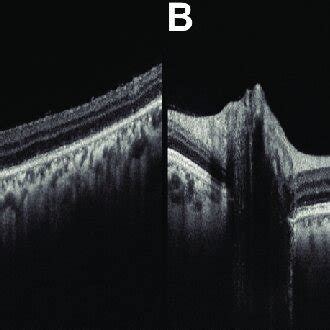 A Swept Source Optical Coherence Tomography Ss Octa Of The Left Eye