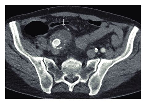 Contrast Enhanced Computed Tomography Axial Image Of The Soft Tissue