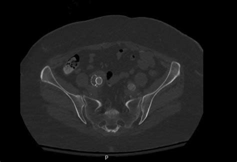 Hypogastric Artery Thrombectomy For Spinal Cord Ischemia Following