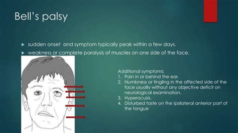 Management Of Bells Palsy Ppt