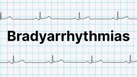 How To Identify Bradyarrhythmias Ausmed