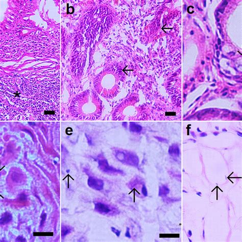 Analysis Of Histopathology Fish And Pcr In The Gastric And Esophageal