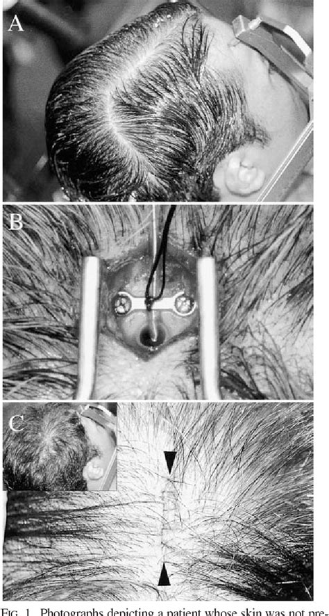 Figure 1 From Implantation Of Deep Brain Stimulation Electrodes In Unshaved Patients Semantic