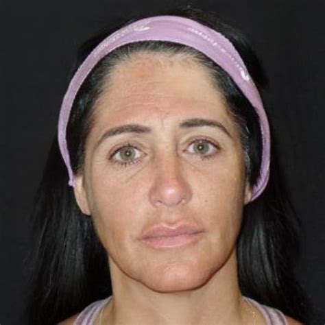 Liquid Facelift Before After Case Female Age Dr