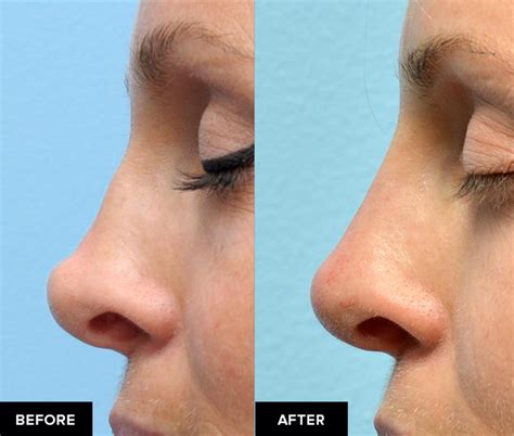 Non Surgical Nose Job After Rhinoplasty Is It Safe Updated 2023