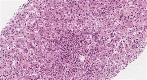 Autoimmune hepatitis | Ottawa Atlas of Pathology