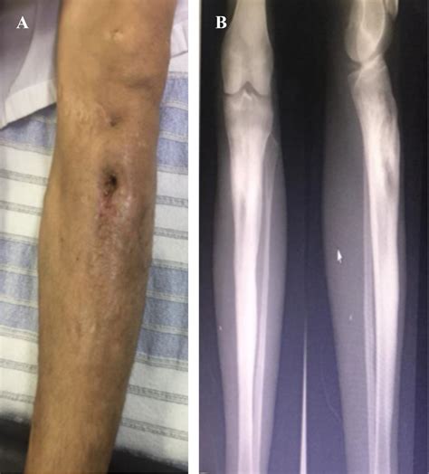 Osteomielitis Crónica De Tibia Uso De Vidrio Biactivo Como Complemento