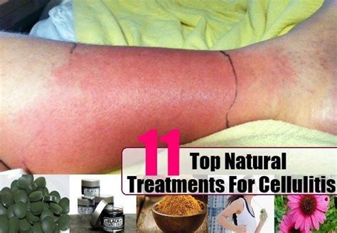 Treatments For Cellulitis Cellulitis Treatment Natural Cures Natural Treatments