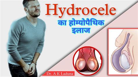 Hydroceles Homeopathic Treatment Youtube