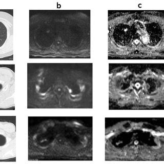 A Ct B Dwi C Adc Map D T Wi Case Hamartoma Adc