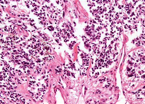 Oat Cell Carcinoma At 20x Magnification Nikon’s Microscopyu