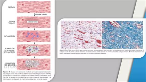 Inflamacion Granulomatosa Patolog A Ppt