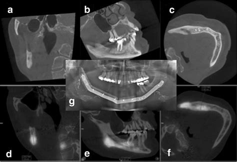 A 57 Year Old Female Patient With Chronic Osteomyelitis Screenshots Of Download Scientific