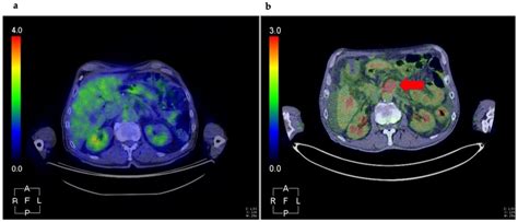 Cancers Free Full Text The Role Of Positron Emission Tomography