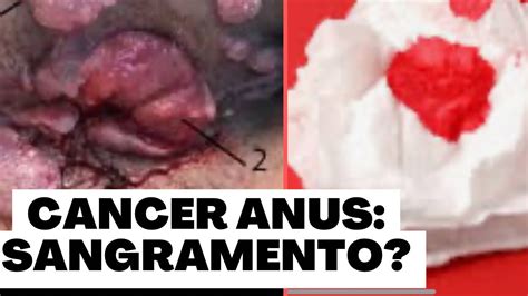 Câncer anus Saibam c é o sangramento desse tumor no grupo de risco