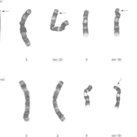 G Banded Partial Karyotypes Of Chromosomes And For A The Mother