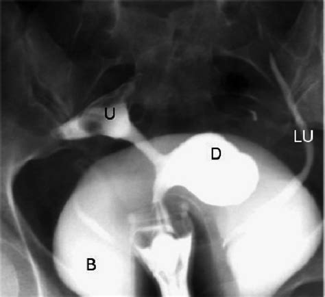 Conventional Hysterosalpingogram Showing A Contrast Filled Left