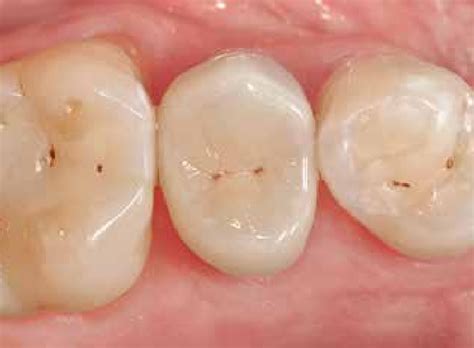 Restoration with morphological and functional occlusal reconditioning ...