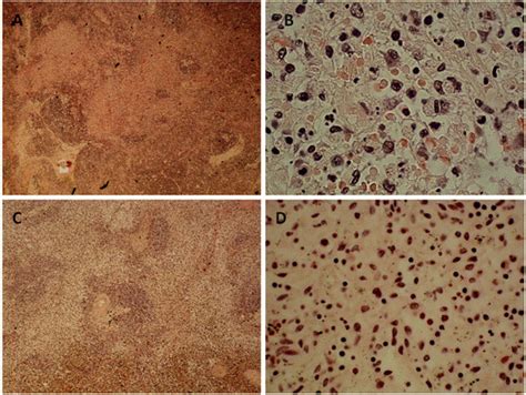 Histology of lymph nodes and spleen from Case 1. A-B: Low (x100) and ...