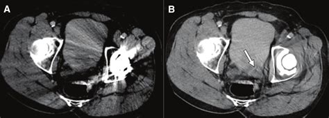 Metal Artifact Reduction Axial Ct Images Of The Pelvis Including A