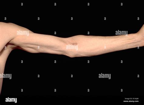 lipodystrophy syndrome  res stock photography  images alamy