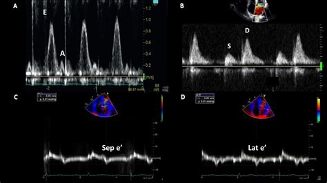 Practical Points For Echocardiography In Cardiac Amyloidosis Journal