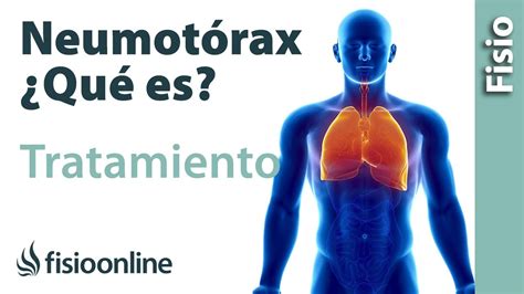 Neumot Rax Qu Es Consejos Y Tratamiento A Trav S De La Fisioterapia