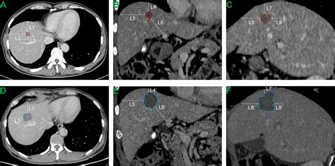 Frontiers Comparison Of Percutaneous Radiofrequency Ablation For