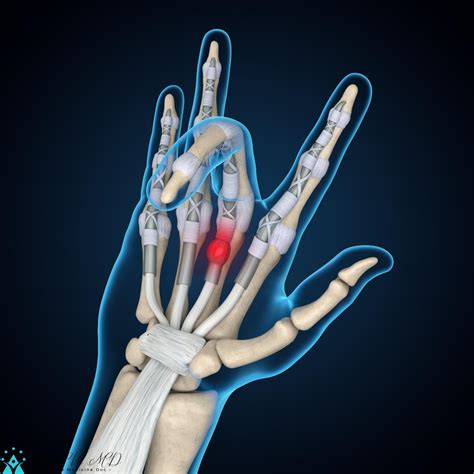 Trigger Finger 3d Rendering Finger Anatomy Hand Anatomy Exercisenow