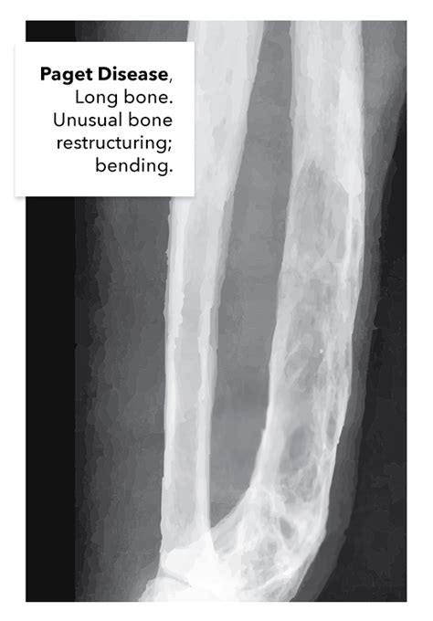 [figure Paget Disease Of The Long Bone] Statpearls Ncbi Bookshelf