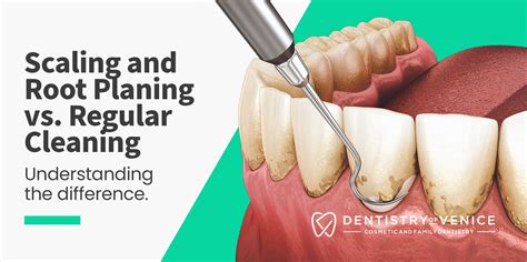 Scaling And Root Planing Vs Regular Cleaning