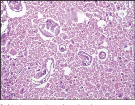 Pdf Ascaris Lumbricoides As Etiologic Factor For Pancreas Inflammatory Tumor Semantic Scholar