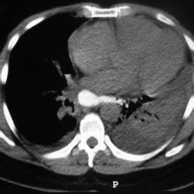 CT Scan Revealing Bilateral Pleural Effusions And Gastrografin Leak