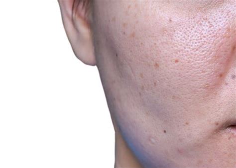 Laser Skin Resurfacing Pores