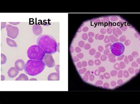 Lymphocyte Or Blast How Do You Tell The Difference YouTube