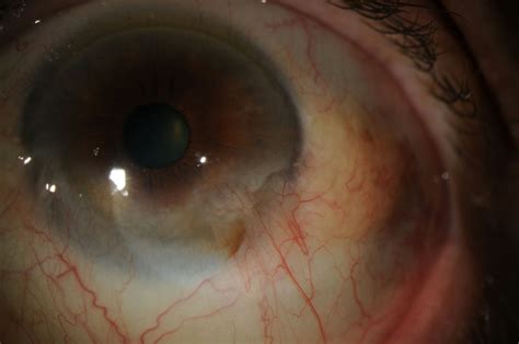 Moran Core Limbal Stem Cell Deficiency Image Report