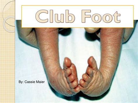 Ppt Club Foot Powerpoint Presentation Free Download Id2103716