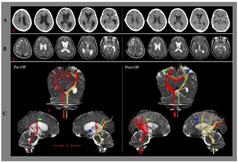 Hydrocephalus Before And After Shunt