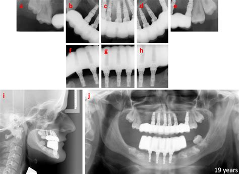 Radiographic Overviews Of The Implant Fixed Bridges At The Time Of