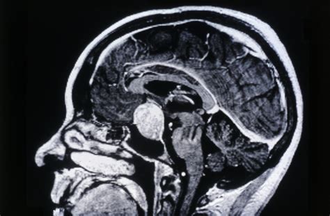 Visual Dysfunction an Important Element in Morbidity of Pituitary ...