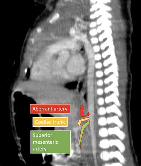 Pulmonary Sequestration Extralobar Image Radiopaedia Org