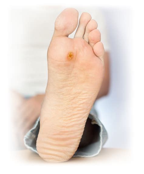 Ulcer On Your Foot Clearance