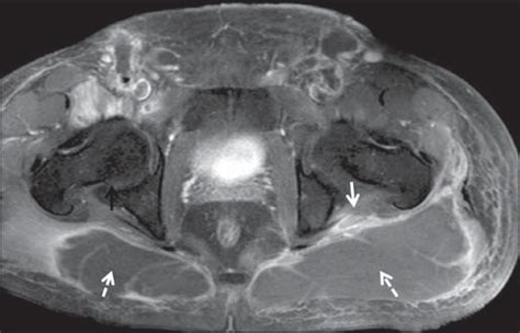 Scielo Brasil Sciatic Neuropathy Findings On Magnetic Resonance