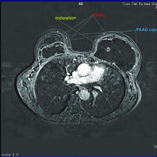 MRI Image Of A 40 Year Old Female Who Underwent Breast Augmentation