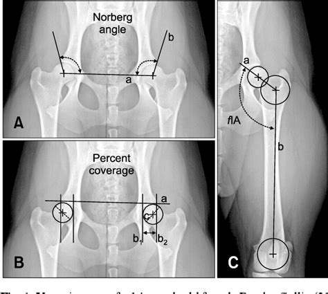 Figure From Effects Of Intertrochanteric Varus Osteotomy On Norberg