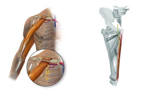 gracilis functional  muscle transfer  brachial plexus