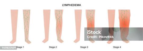 Stades Du Lymphœdème Vecteurs Libres De Droits Et Plus Dimages