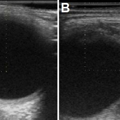 Ultrasound Of The Lacrimal Glands After Treatment Left A And Right