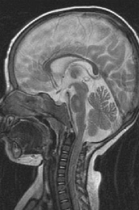 Brain MRI Showing Altered Signal Intensity In The Central Pons Due To